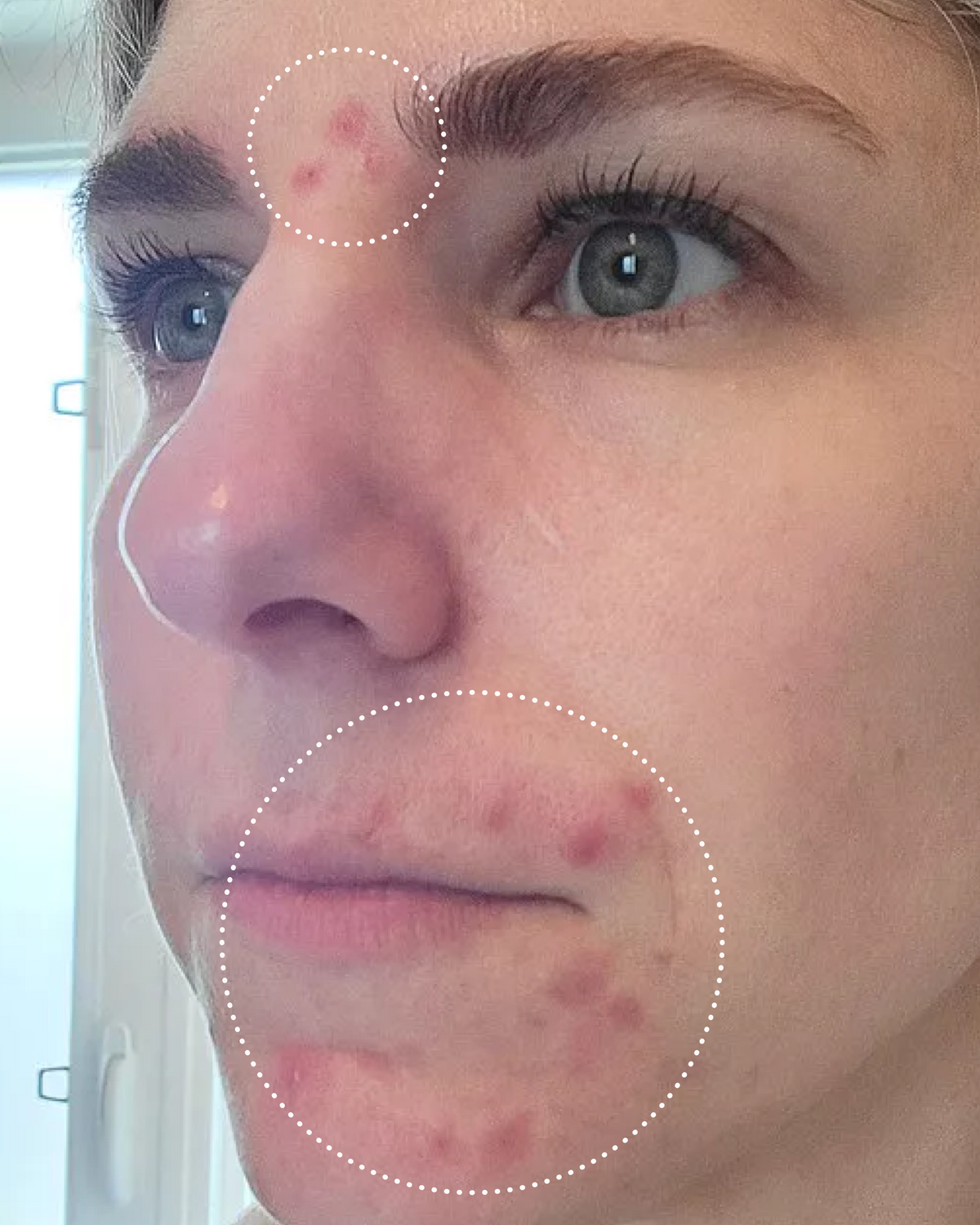Close-up of a person's face with acne on their nose and cheek.