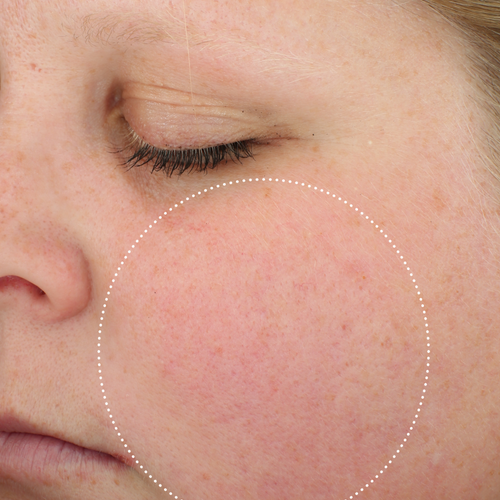 Clinical after photo showing visibly calmer, less red cheek skin following use of Skinfix Antioxidant Tetrapeptide Soothing Treatment, with a dotted circle highlighting the treatment area.