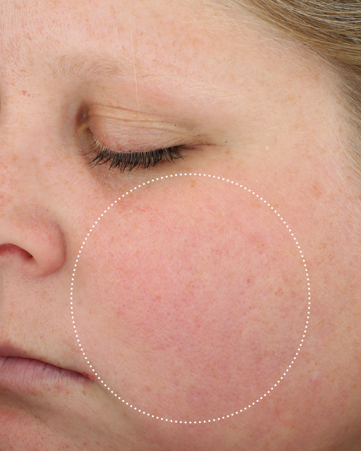 Clinical after photo showing visibly calmer, less red cheek skin following use of Skinfix Antioxidant Tetrapeptide Soothing Treatment, with a dotted circle highlighting the treatment area.