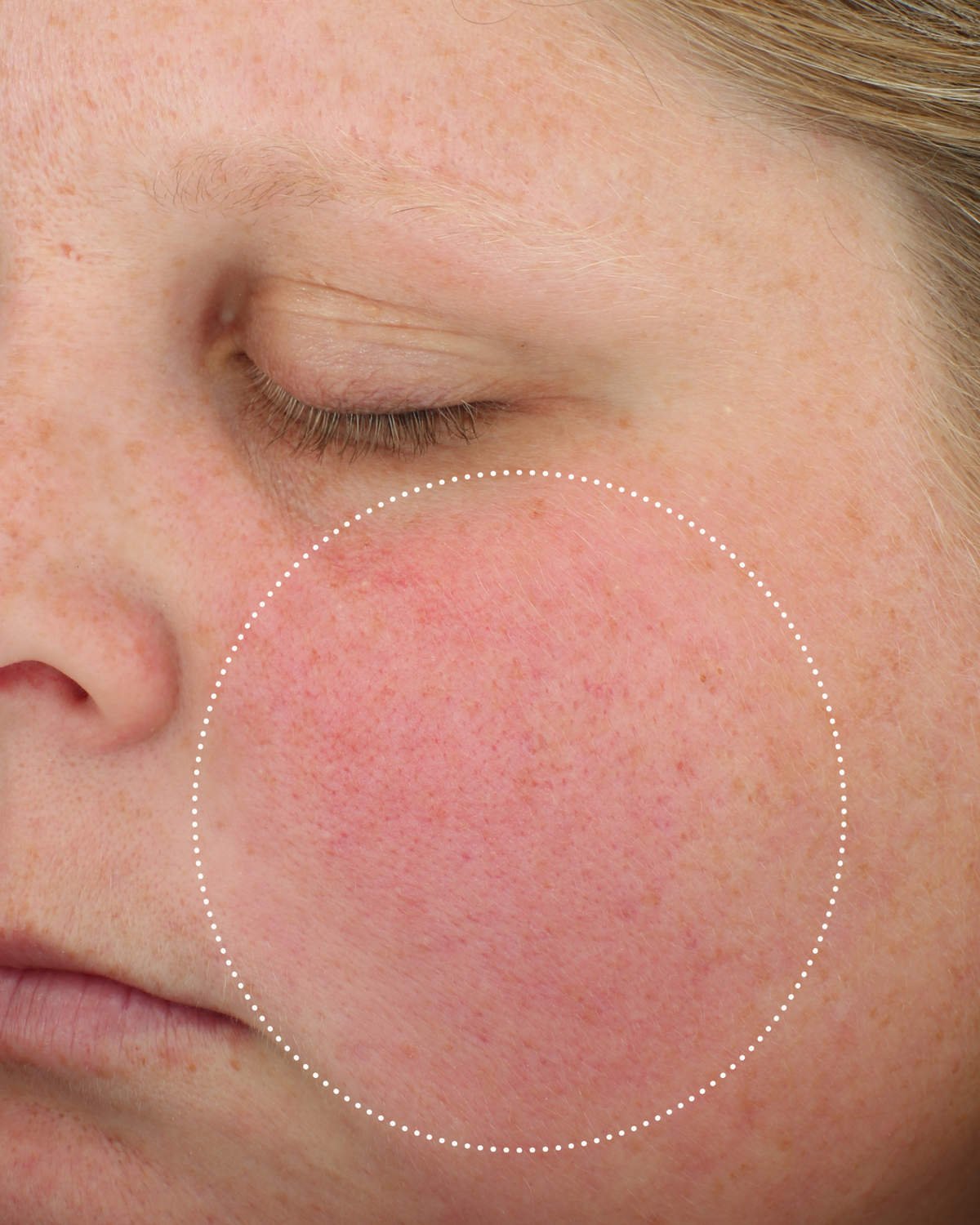 Clinical before photo showing cheek skin with visible redness and uneven tone, with a dotted circle highlighting the treatment area.