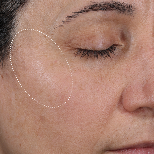 Clinical after photo showing visibly more hydrated, smoother skin around the eye and cheek area after 1 week of using Skinfix Ceramide + Ectoin Gentle Gel Cleanser, with a dotted oval highlighting the treatment area.
