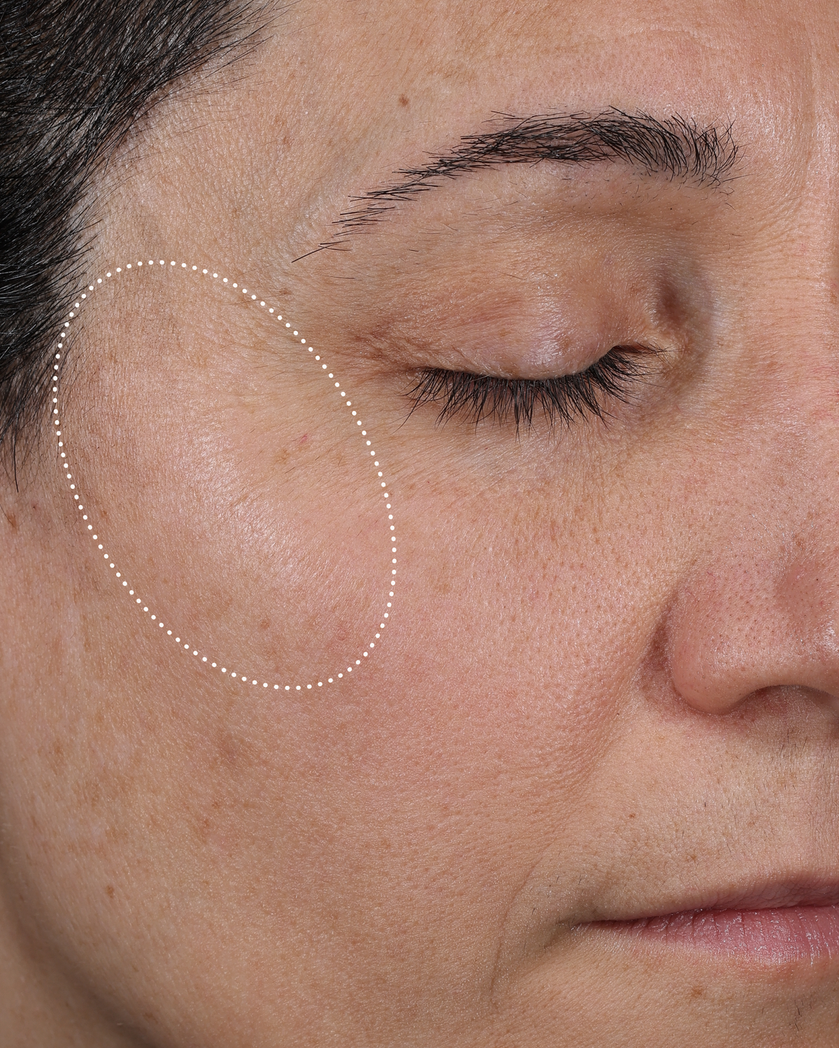 Clinical after photo showing visibly more hydrated, smoother skin around the eye and cheek area after 1 week of using Skinfix Ceramide + Ectoin Gentle Gel Cleanser, with a dotted oval highlighting the treatment area.