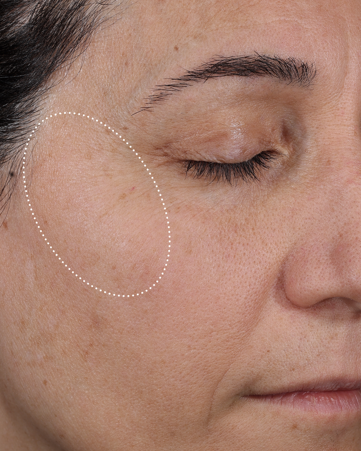 Clinical before photo showing skin dryness and uneven texture around the eye and cheek area, with a dotted oval highlighting the treatment area.