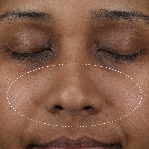 Clinical after photo showing visibly less shine and more balanced-looking skin across the nose and cheek area following use of Skinfix Balancing Soft-Foam Clay Cleanser, with a dotted oval highlighting the treatment area.