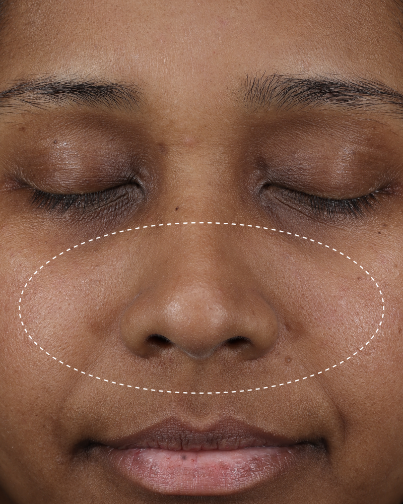 Clinical after photo showing visibly less shine and more balanced-looking skin across the nose and cheek area following use of Skinfix Balancing Soft-Foam Clay Cleanser, with a dotted oval highlighting the treatment area.