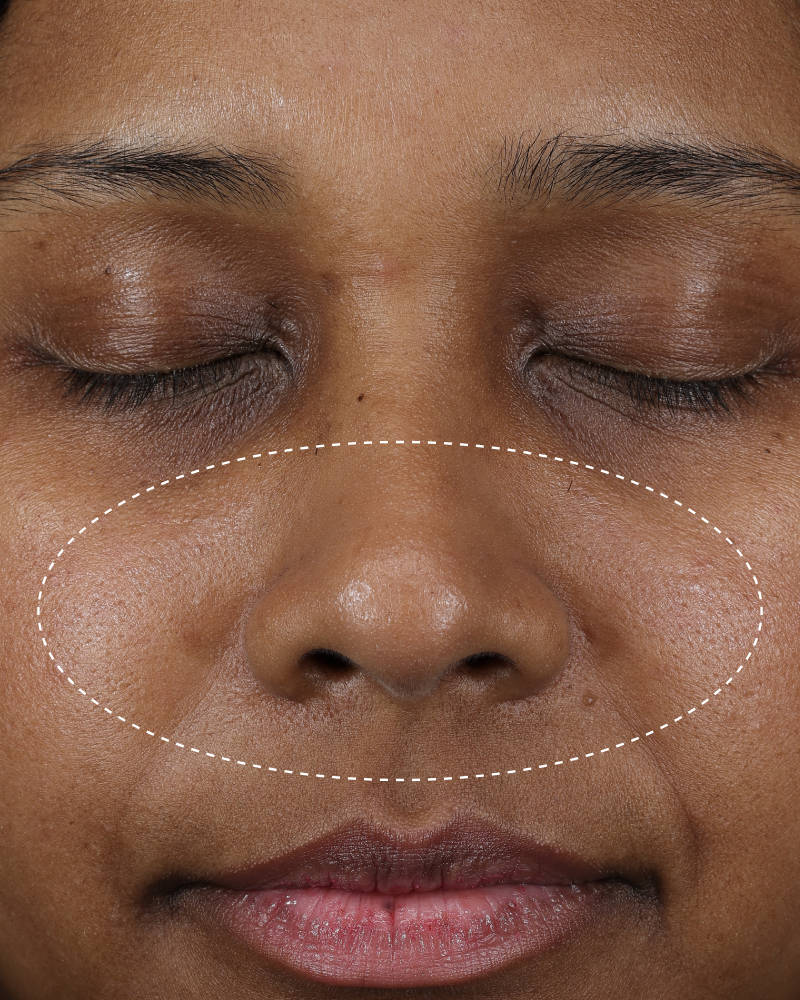Clinical before photo showing visible shine and uneven texture across the nose and cheek area, with a dotted oval highlighting the treatment area.