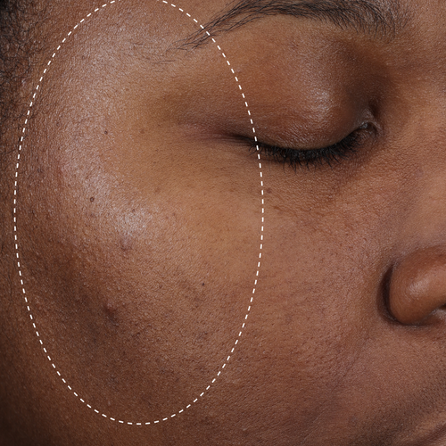 Clinical after photo showing visibly less shine and more balanced-looking skin on the cheek following use of Skinfix Balancing Soft-Foam Clay Cleanser, with a dotted circle highlighting the treatment area.