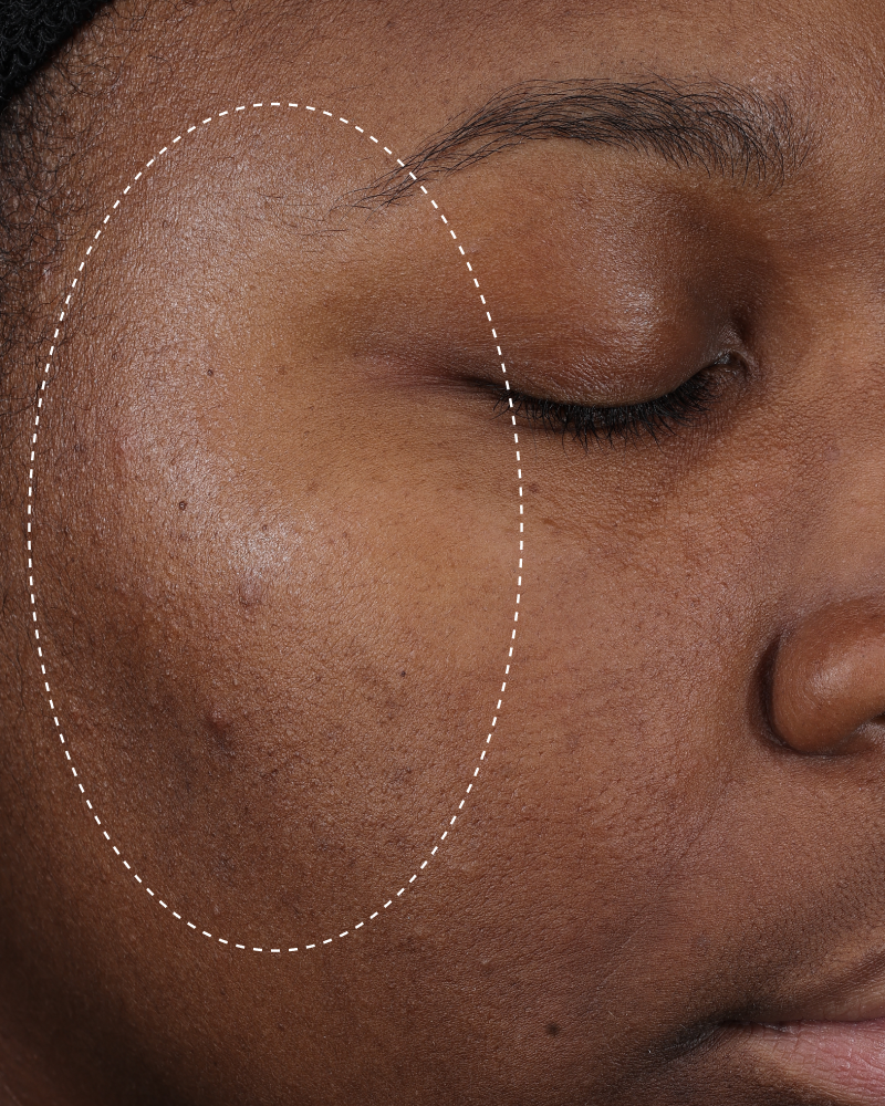 Clinical after photo showing visibly less shine and more balanced-looking skin on the cheek following use of Skinfix Balancing Soft-Foam Clay Cleanser, with a dotted circle highlighting the treatment area.