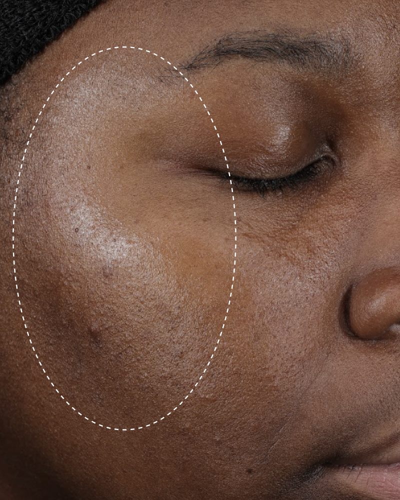 Clinical before photo showing visible shine and uneven texture on the cheek, with a dotted circle highlighting the treatment area.