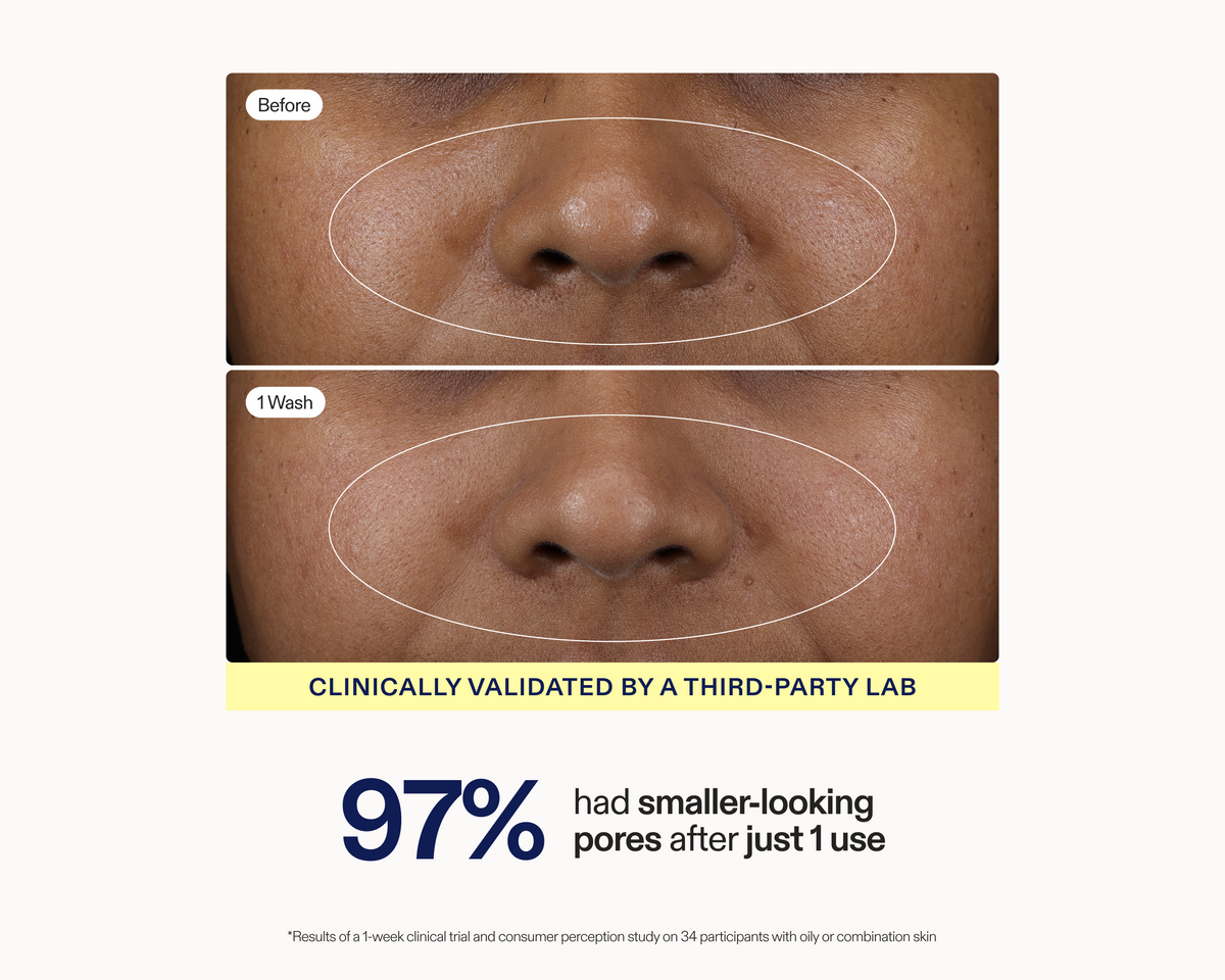 Stacked before and after clinical photos showing visibly smaller-looking pores on the nose and cheek area after 1 wash with Skinfix Balancing Soft-Foam Clay Cleanser, with text reading: Clinically validated by a third-party lab — 97% had smaller-looking pores after just 1 use.
