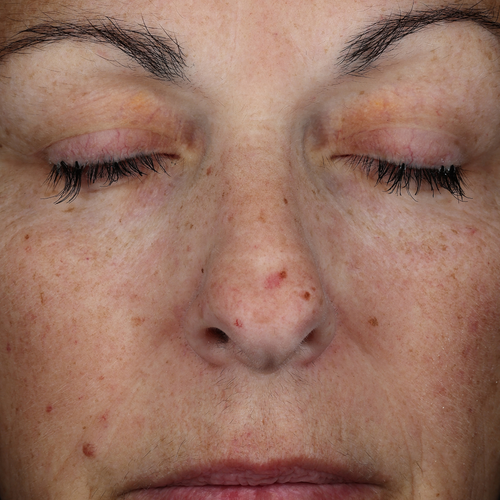 Close-up of the same person’s face with reduced visible redness and a more even-looking skin tone.