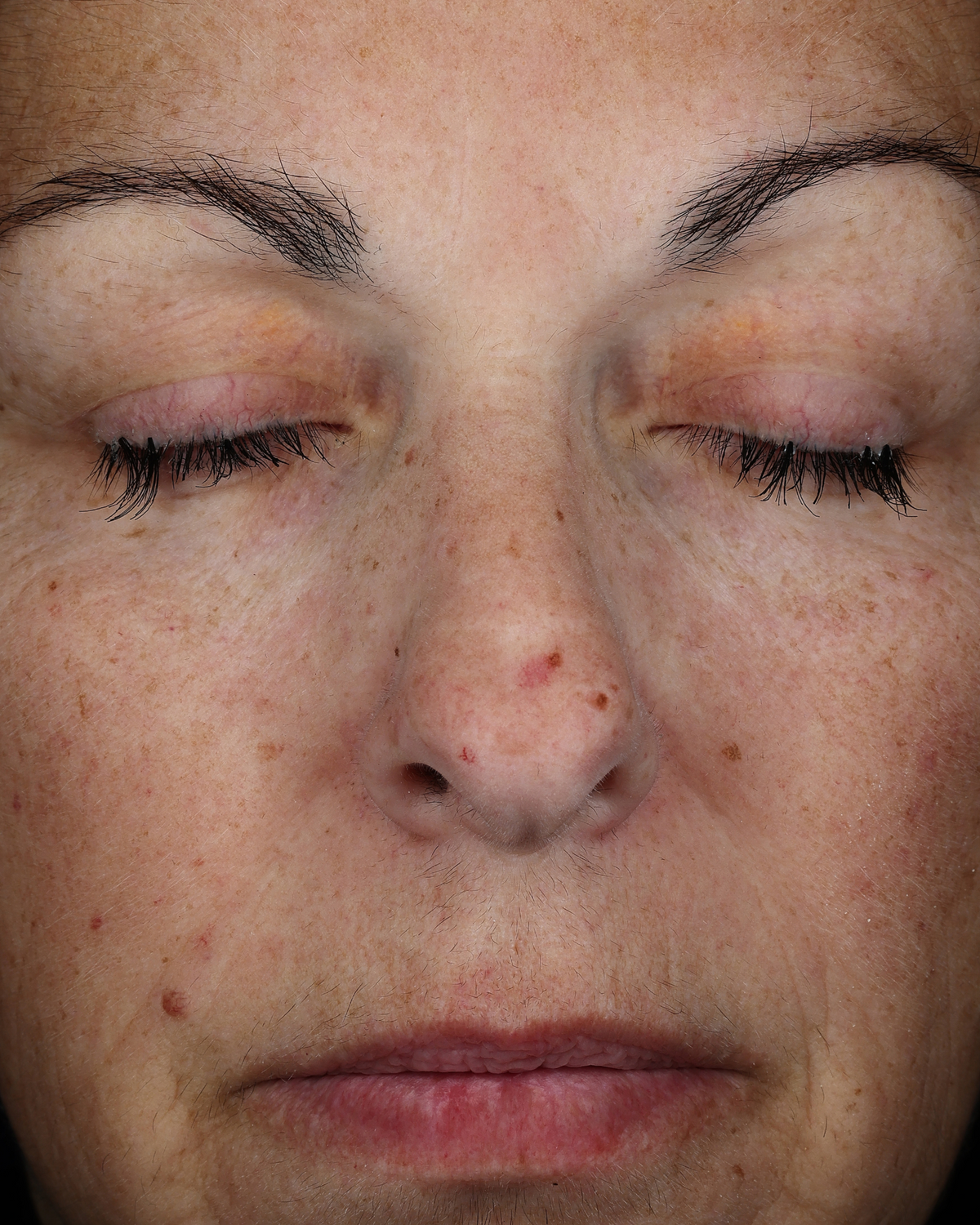 Close-up of the same person’s face with reduced visible redness and a more even-looking skin tone.
