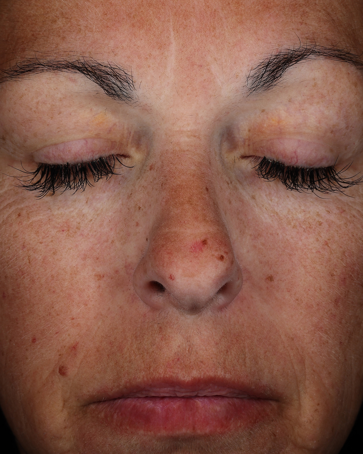 Close-up of a person’s face showing visible redness and uneven skin tone across the cheeks and nose.