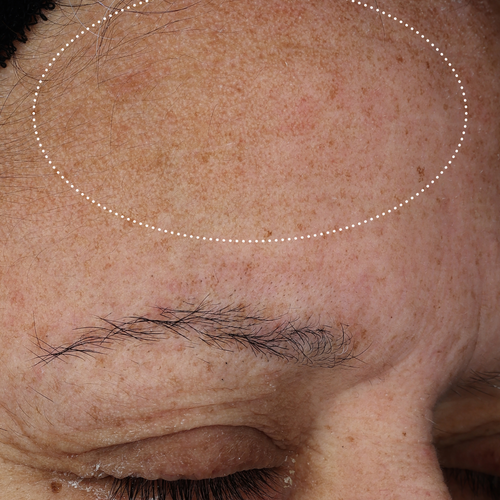 Close-up of the same forehead with reduced visible dryness and a smoother, more even-looking skin texture within the highlighted area.