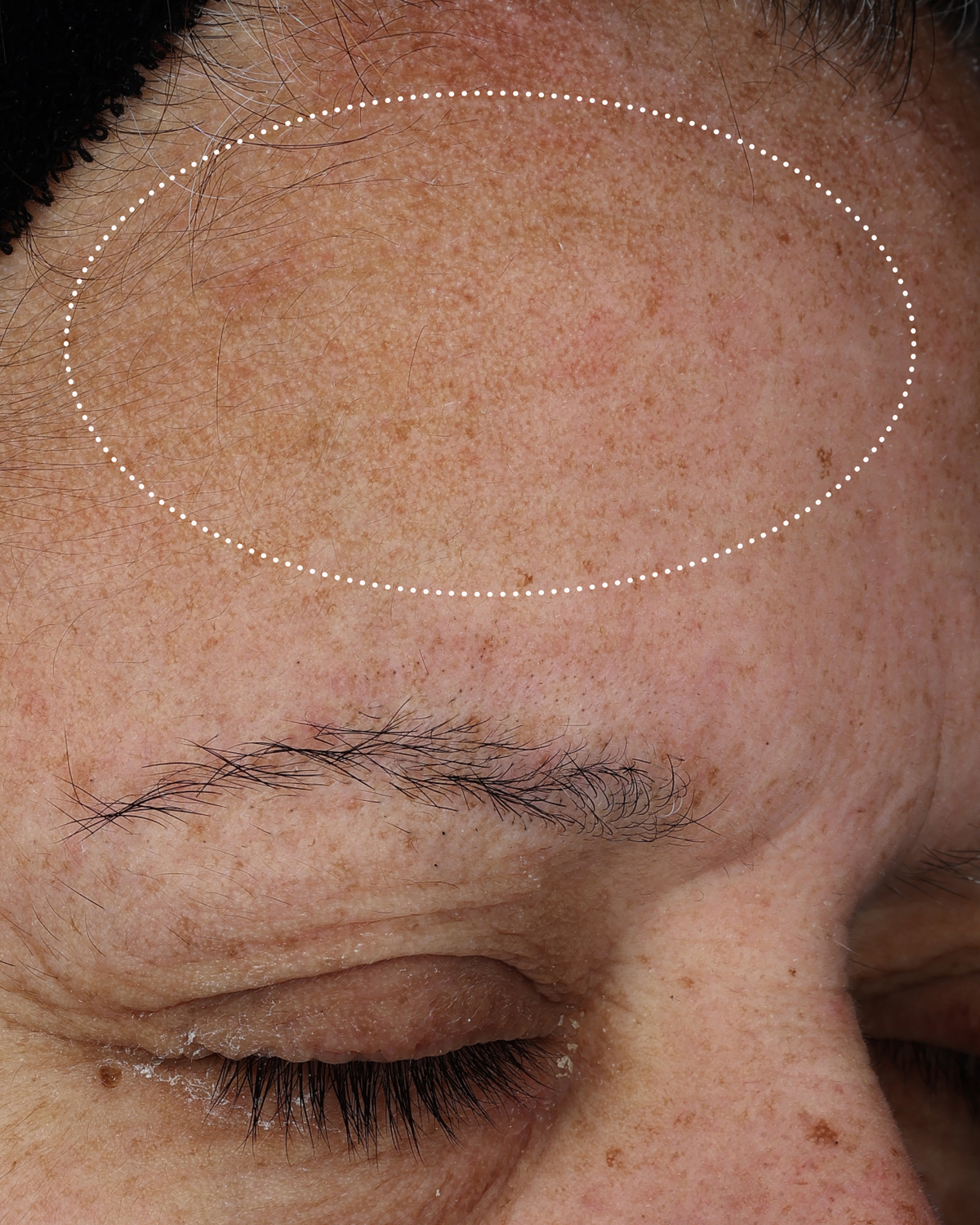 Close-up of the same forehead with reduced visible dryness and a smoother, more even-looking skin texture within the highlighted area.