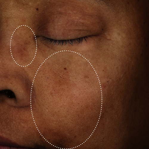 Close-up of the same cheek with visibly reduced redness and a more even-looking skin tone within the highlighted areas.