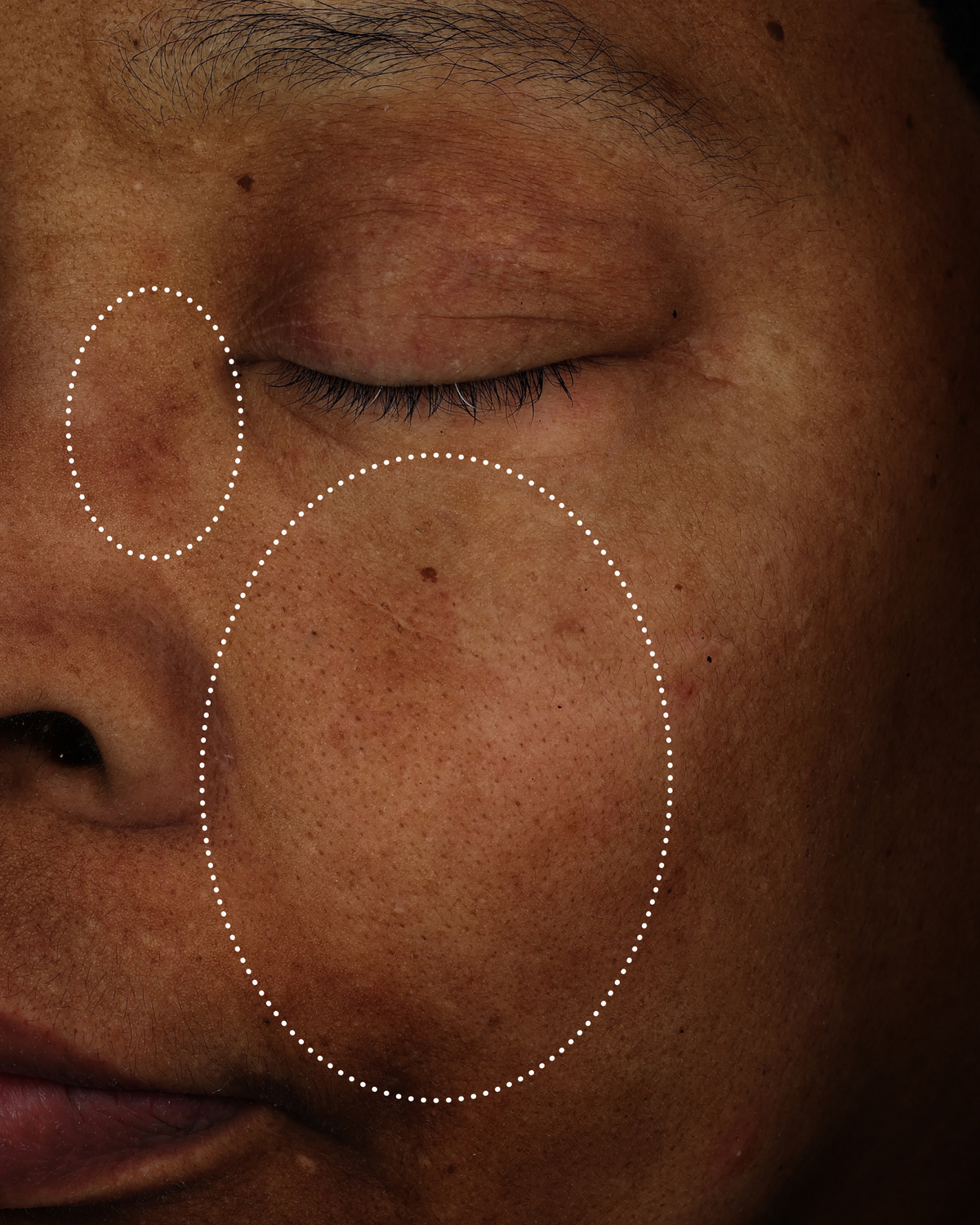 Close-up of the same cheek with visibly reduced redness and a more even-looking skin tone within the highlighted areas.