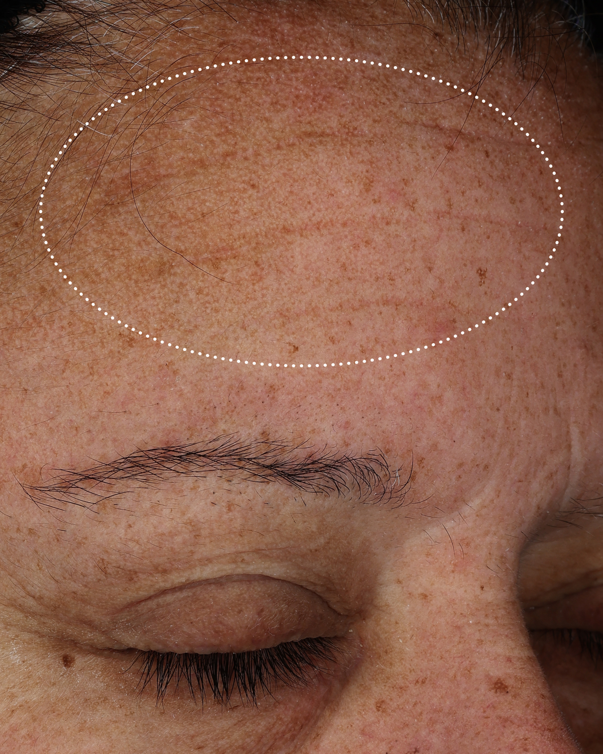 Close-up of a person’s forehead showing visible dryness, uneven texture, and redness within the highlighted area.