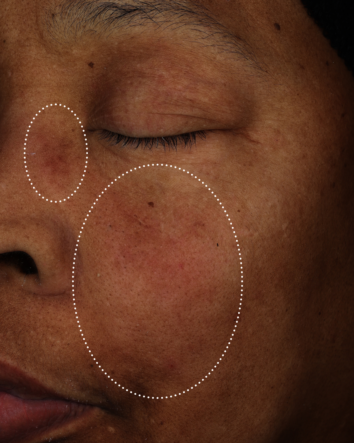 Close-up of a person’s cheek showing visible redness and uneven skin tone, highlighted within dotted areas.