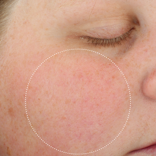 Close-up of the same person’s cheek with reduced visible redness, highlighted by a dotted circle.