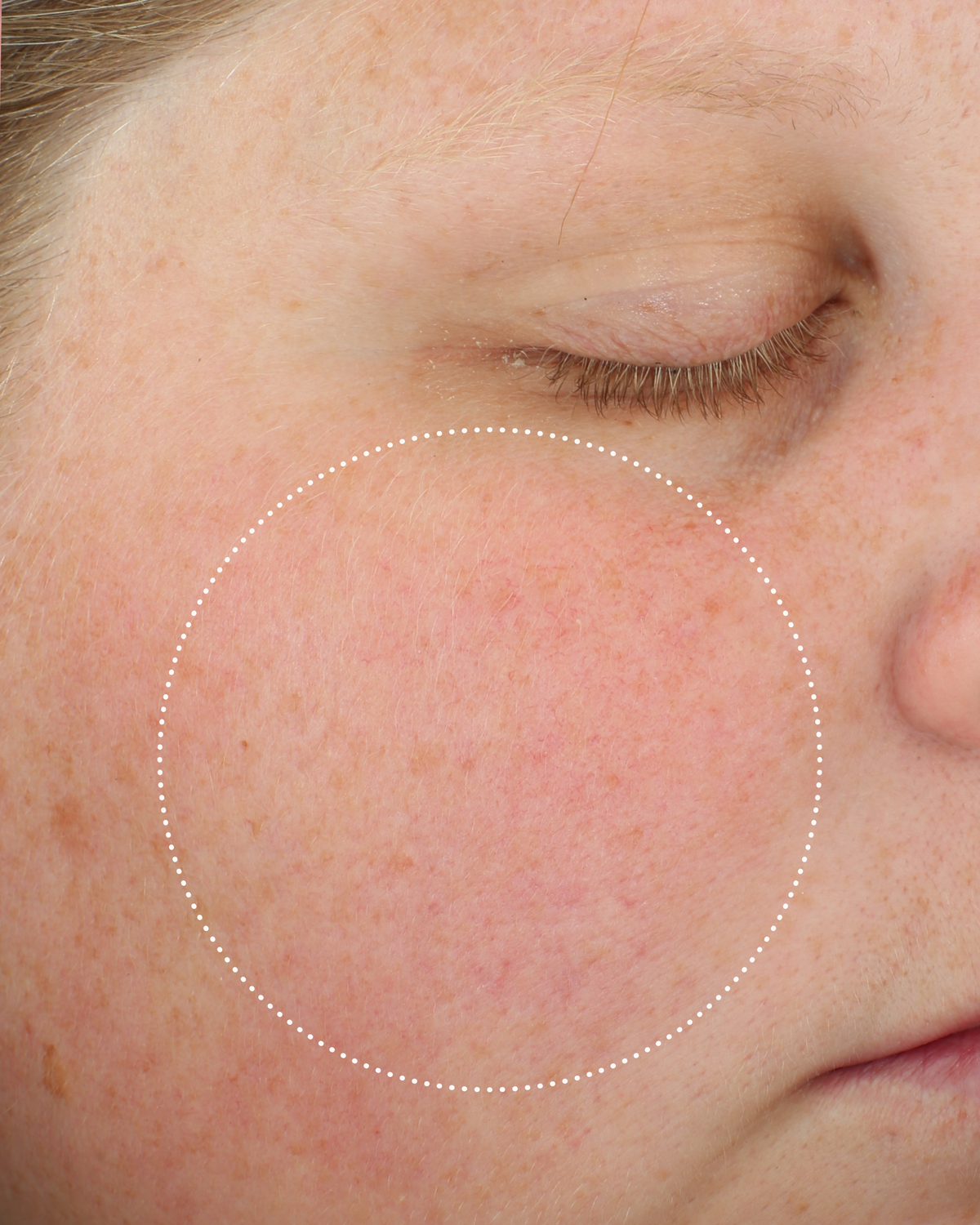 Close-up of the same person’s cheek with reduced visible redness, highlighted by a dotted circle.