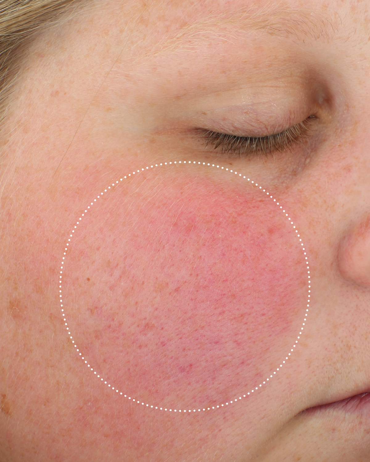Close-up of a person’s cheek with visible redness and irritation, highlighted by a dotted circle.