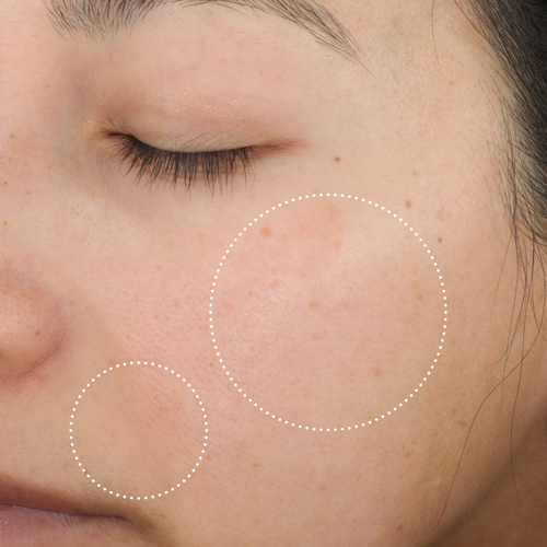 Close-up of the same person’s cheek after use, with dotted circles highlighting changes in the appearance of skin tone and texture.