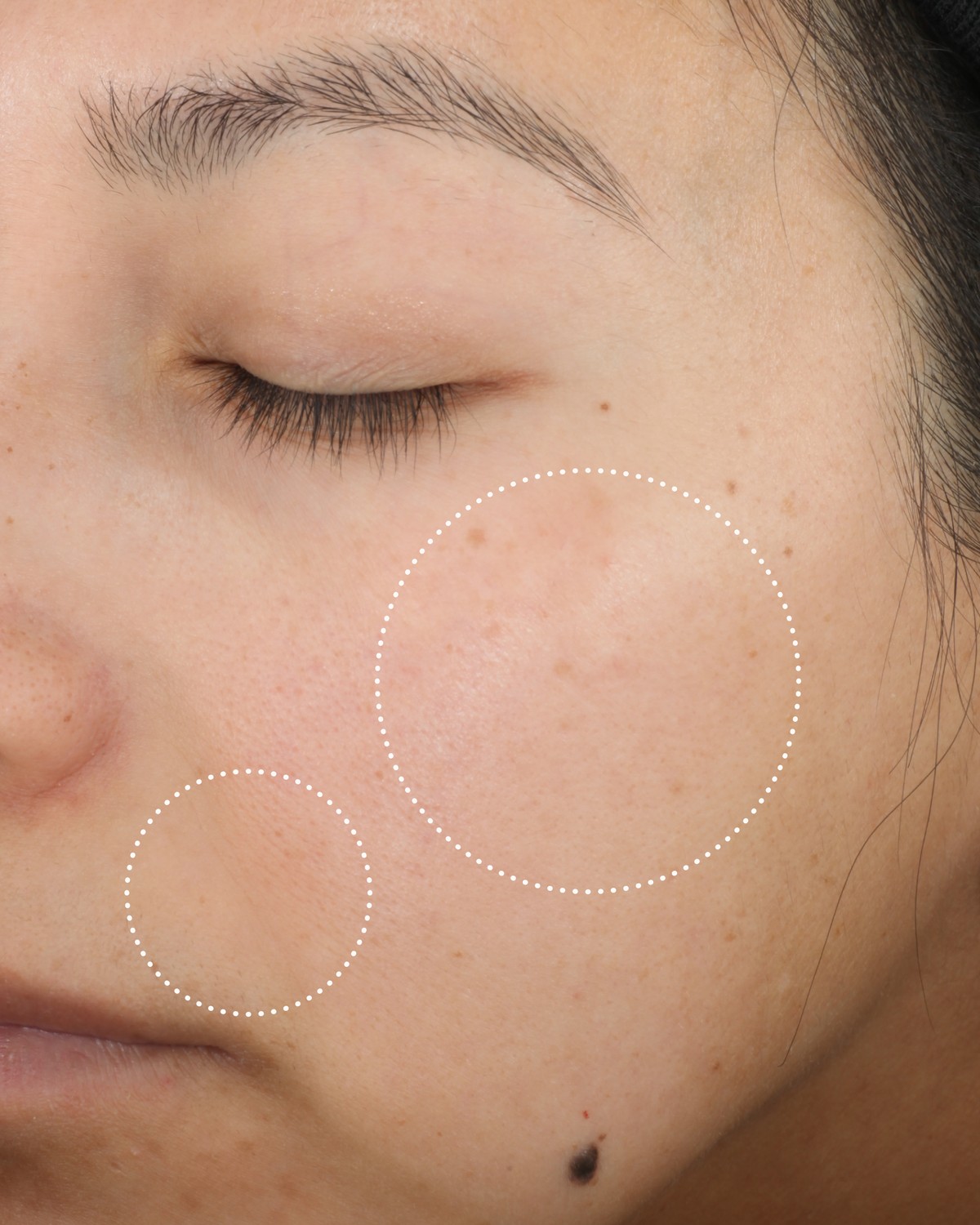 Close-up of the same person’s cheek after use, with dotted circles highlighting changes in the appearance of skin tone and texture.