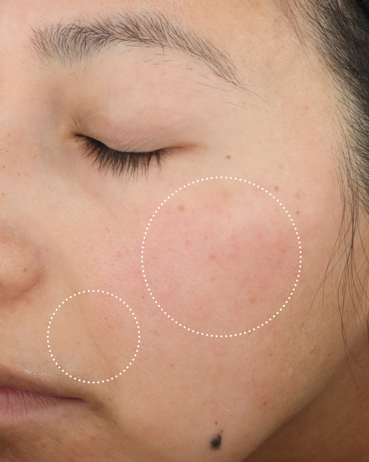 Close-up of a person’s cheek with dotted circles highlighting areas of uneven skin tone and texture.