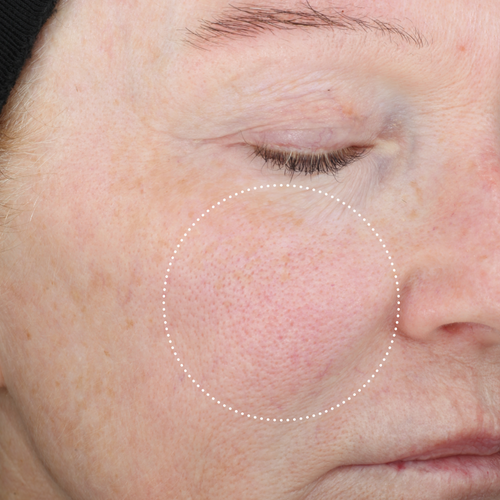 Close-up of the same person’s cheek after use, with a dotted circle highlighting changes in the appearance of redness and skin texture.