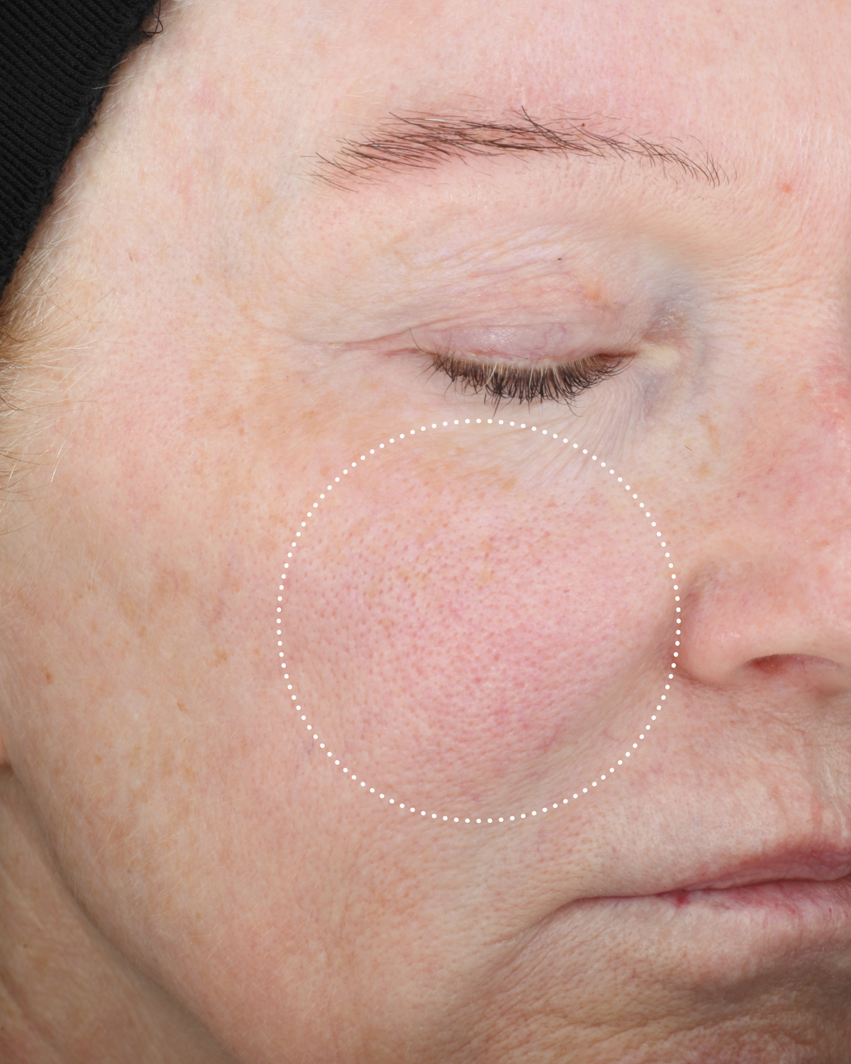 Close-up of the same person’s cheek after use, with a dotted circle highlighting changes in the appearance of redness and skin texture.