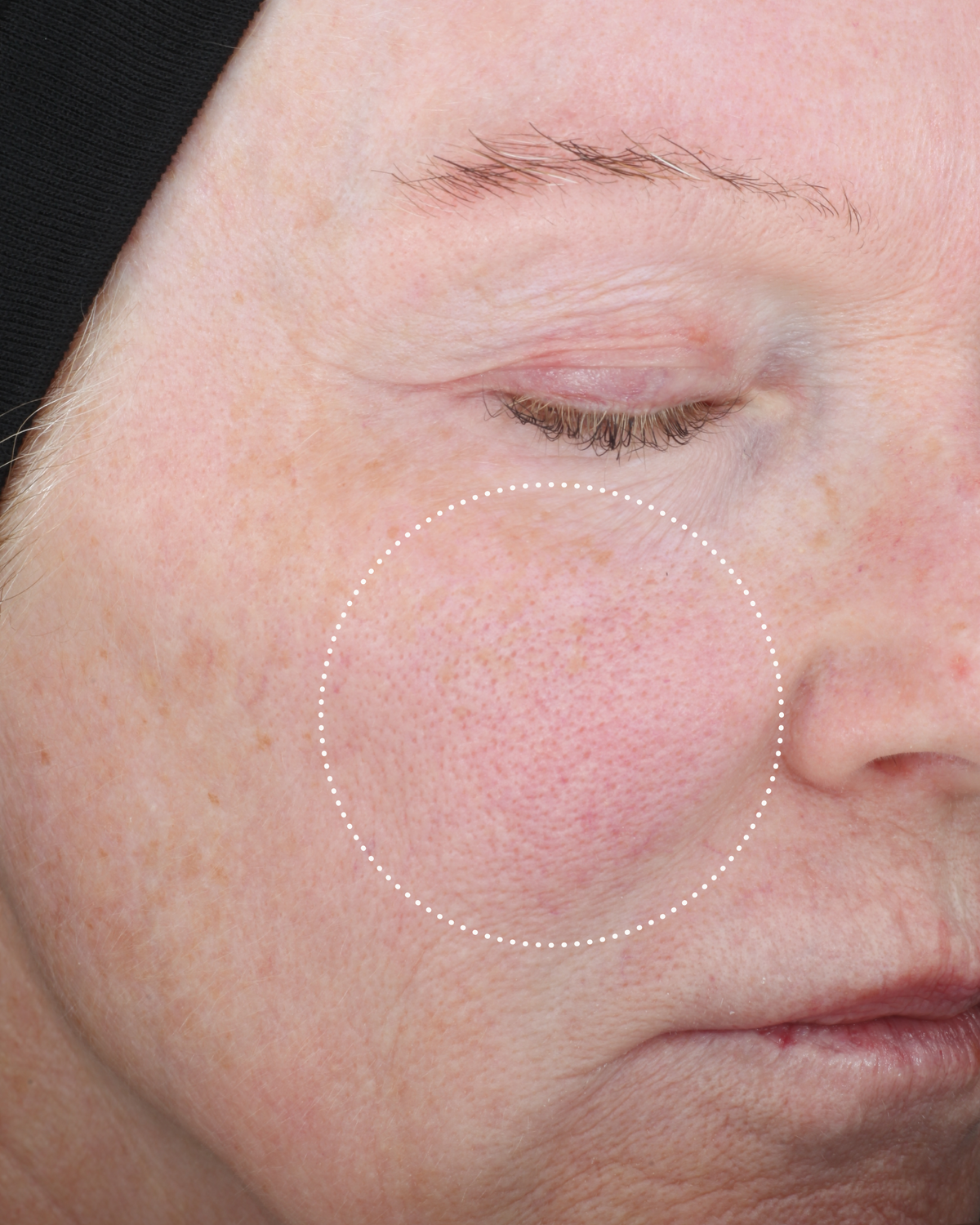 Close-up of a person’s cheek with a dotted circle highlighting visible redness and skin texture.