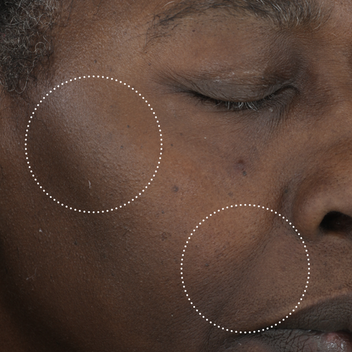 Close-up of the same person’s cheek after use, with dotted circles highlighting changes in the appearance of skin tone and texture.