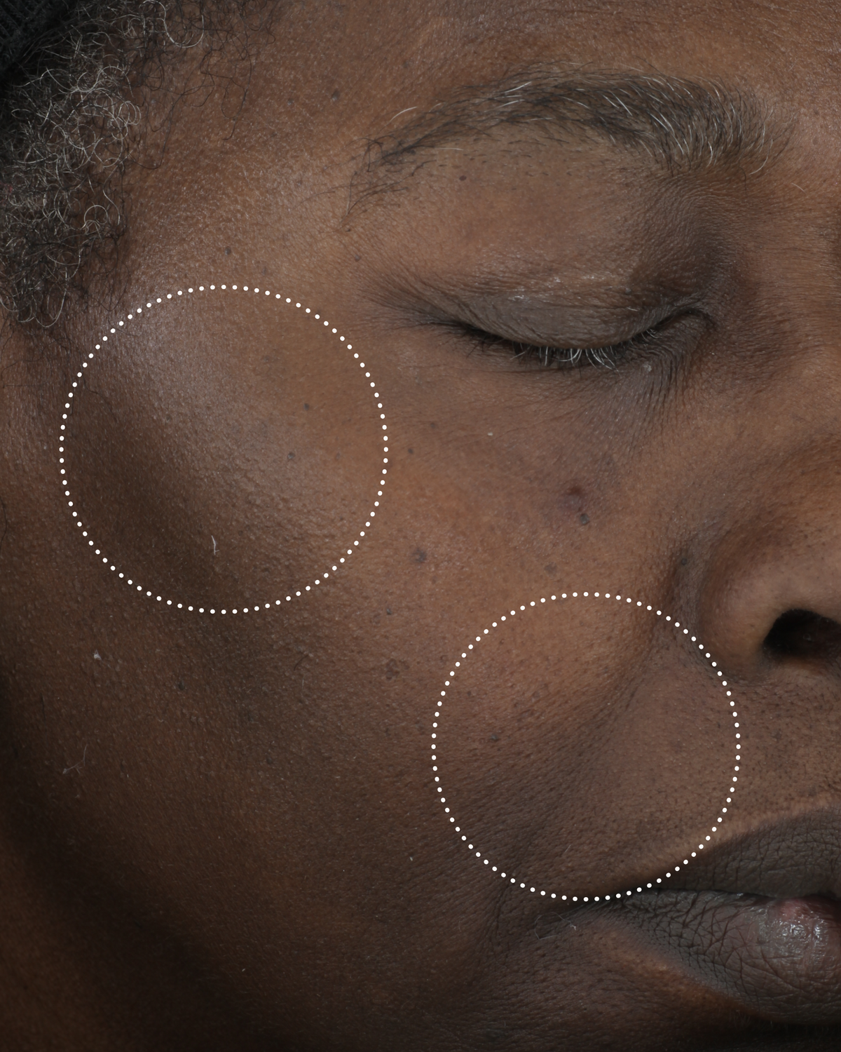 Close-up of the same person’s cheek after use, with dotted circles highlighting changes in the appearance of skin tone and texture.