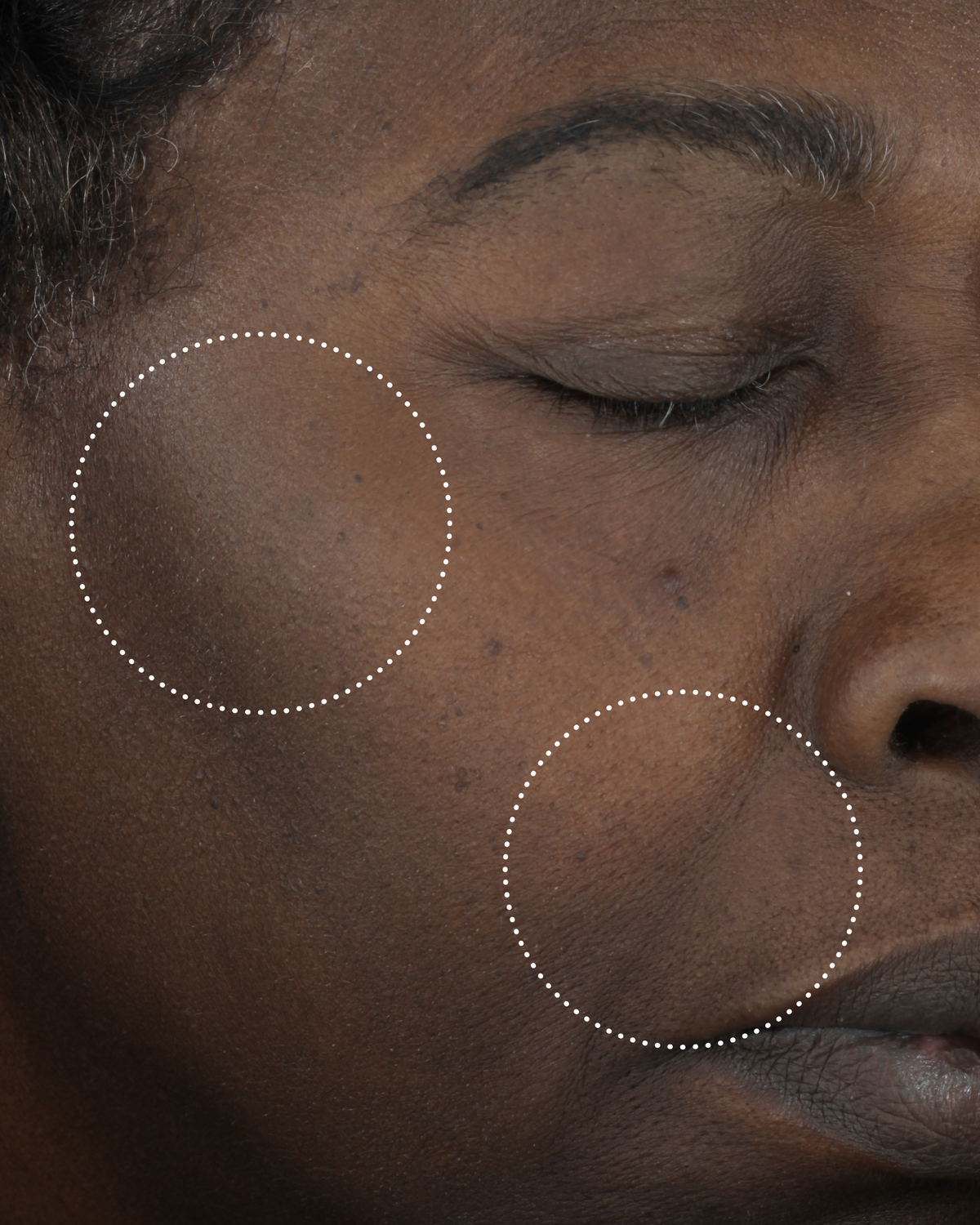 Close-up of a person’s cheek with dotted circles highlighting uneven skin tone and skin texture.
