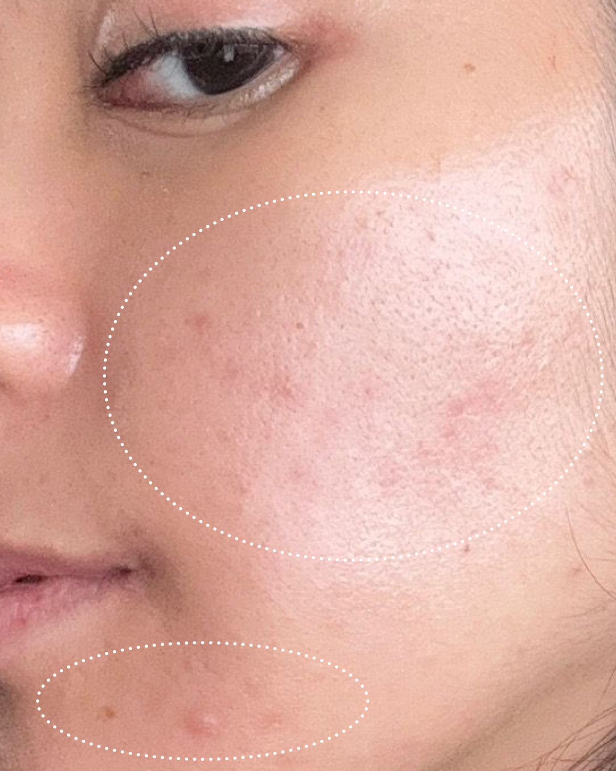 Close-up of a person's face with visibly less blemishes on the skin and brighter skin.
