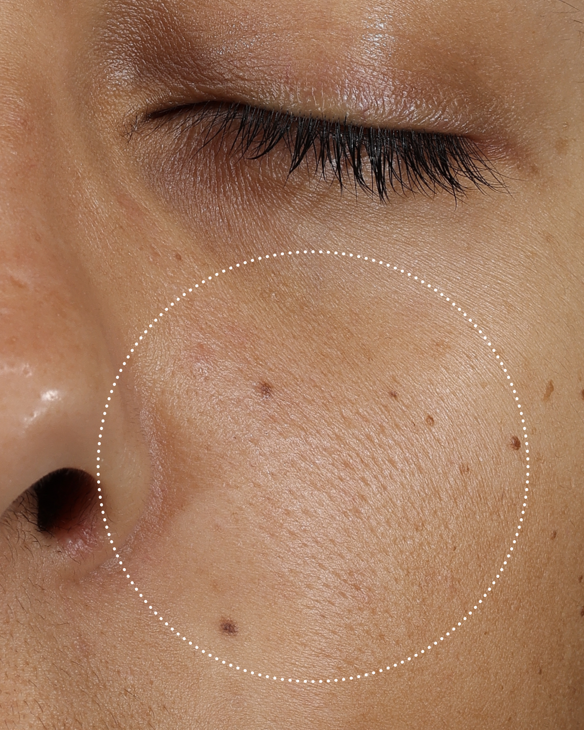 Clinical after photo showing visibly smoother, refined skin texture on the cheek following use of Skinfix Ceramide Prime Whipped Cream, with a dotted circle highlighting the treatment area.